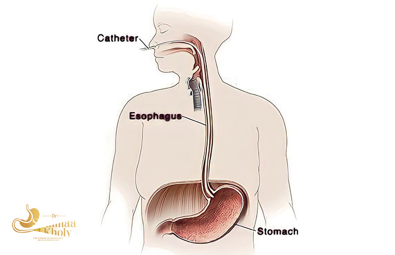 The Importance of High-Resolution Esophageal Manometry