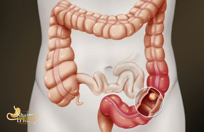 أنواع زوائد القولون وطرق علاجها