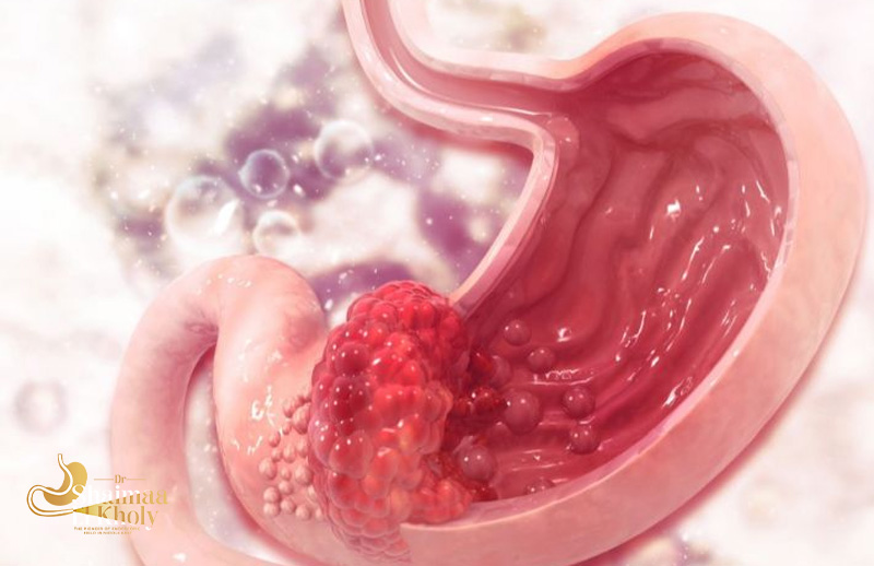 علاج-ورم-المعدة-الحميد