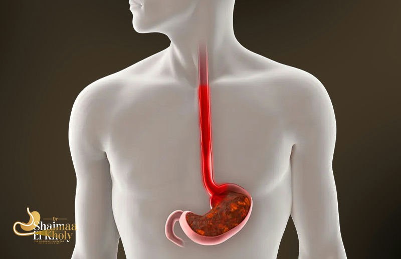 عملية ارتجاع المريء جردكس GERD-X