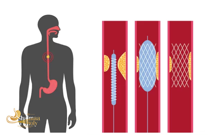 ما-هي-أنواع-الأكاليزيا-وطرق-العلاج-منها؟