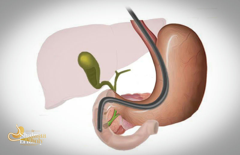 مناظير القنوات المرارية (ERCP)