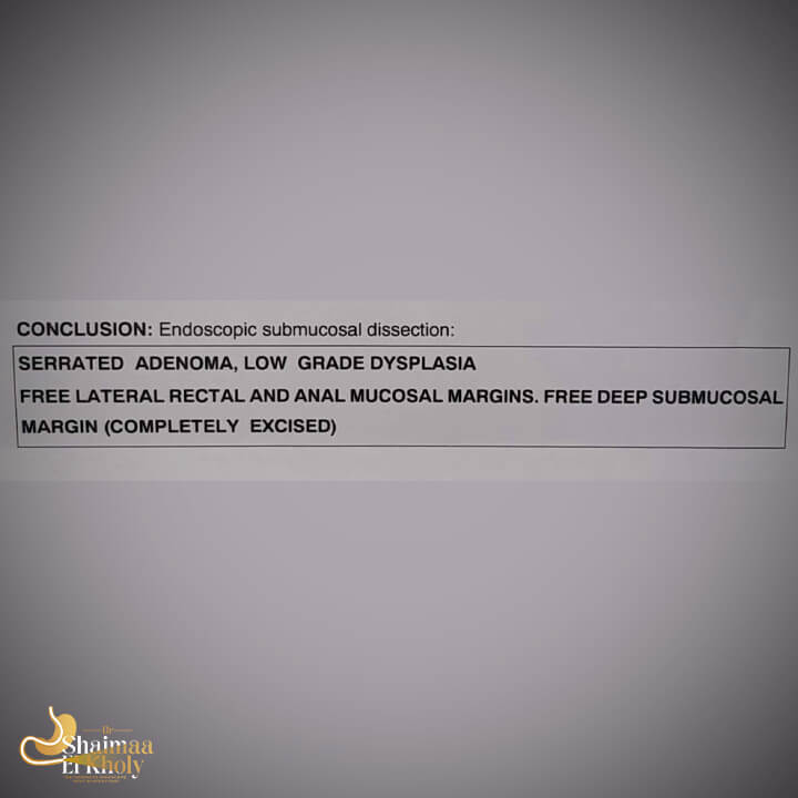 استئصال ورم صعب بسبب شدة الالتصاقات